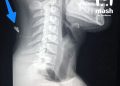 Боец в ЛНР выжил после ранения осколком в шею