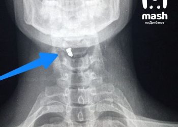 Боец в ЛНР выжил после ранения осколком в шею