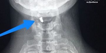 Боец в ЛНР выжил после ранения осколком в шею