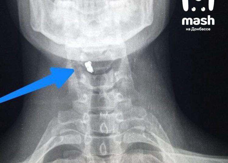 Боец в ЛНР выжил после ранения осколком в шею