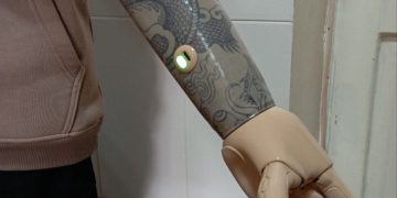 Девять детей из ЛНР получили бионические протезы Девять детей из ЛНР получили бионические протезы