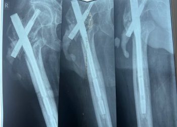 В Луганске провели уникальную операцию по восстановлению ноги ветерана СВО