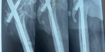 В Луганске провели уникальную операцию по восстановлению ноги ветерана СВО